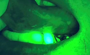 口腔内蛍光観察装置 Oralook（オラルック）